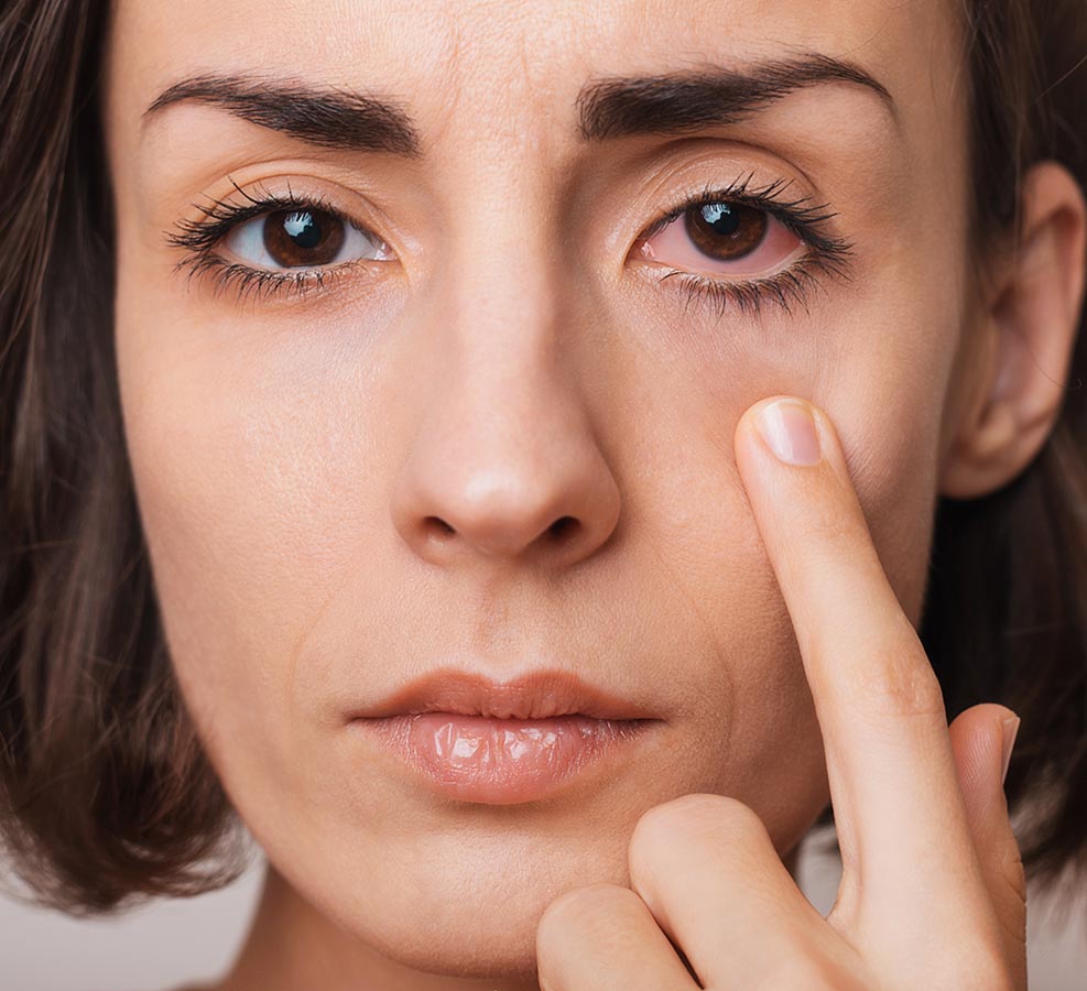 Woman touching the skin below her irritated eye